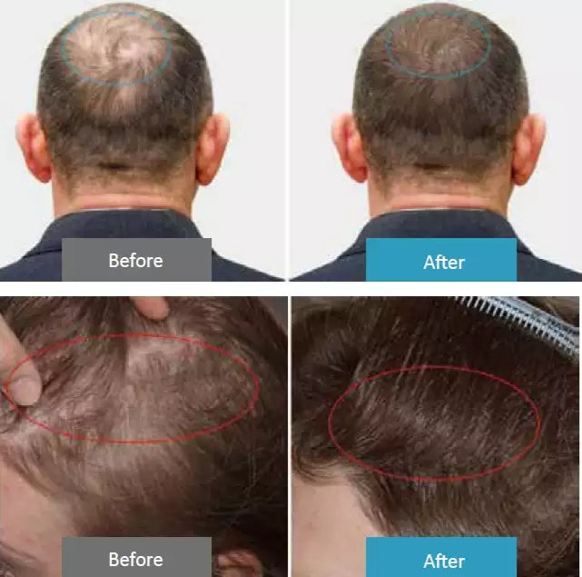 HD-CurePro: dispositivo láser compuesto de mano para aliviar el dolor y hacer crecer el cabello