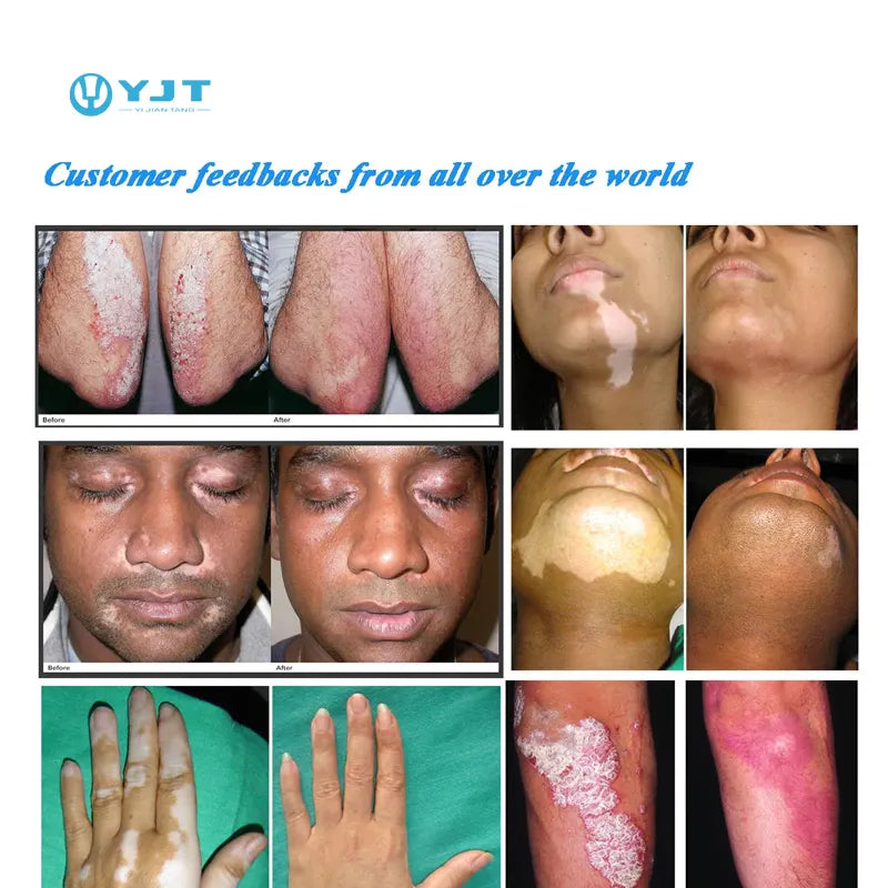 Lámpara de terapia de luz UVB para enfermedades de la piel