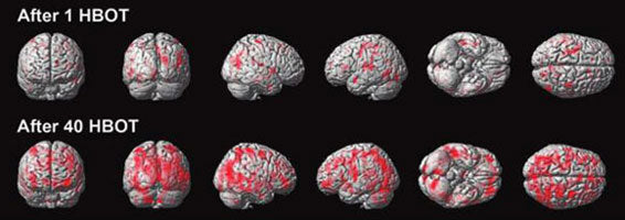Uno Vita – Chambre à pression d'oxygène (HBOT – horizontale – 1,5 ATA)