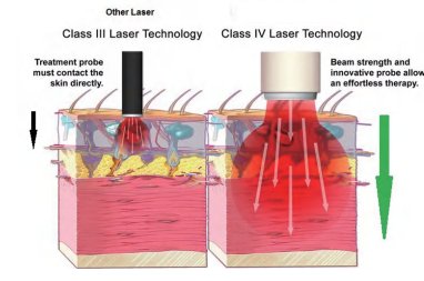 HD-CureX (Class IV laser) - Uno Vita AS