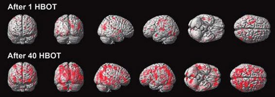 Uno Vita - Syretryck - kammare (HBOT - horisontell - 1,5 ATA) - Uno Vita AS