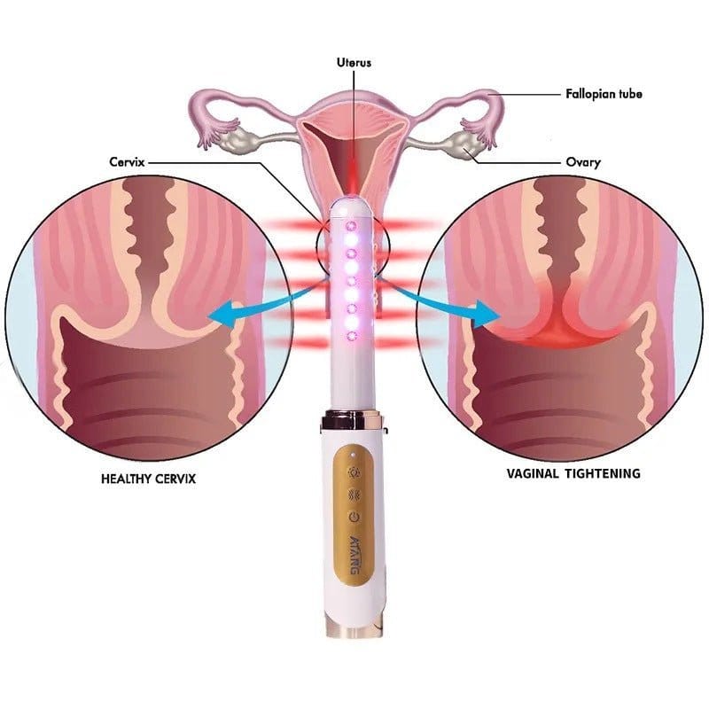 Láser vaginal rejuvenecedor de Uno Vita - Uno Vita AS