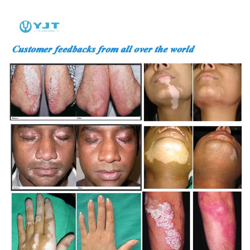 UVB Light Therapy Lamp for Skin Diseases - Uno Vita AS