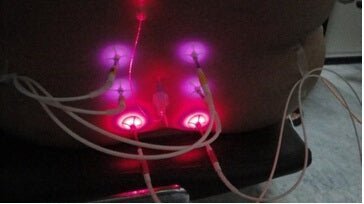 Weberneedle® Endo-Lasersystem - Uno Vita AS