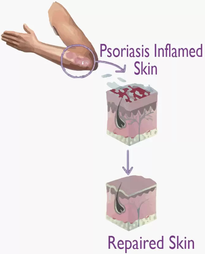 OLIVIE DERMAPSORIA - Combattez le Psoriasis et l'Eczéma NATURELLEMENT !