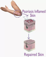 OLIVIE DERMAPSORIA - Combattez le Psoriasis et l'Eczéma NATURELLEMENT !