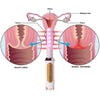 Uno Vitas foryngende vaginal-laser med vibrasjon - Uno Vita AS